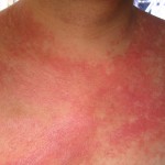 Tips on How to Treat Psoriasis