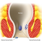 The Benefits of Natural Remedies for Hemorrhoids