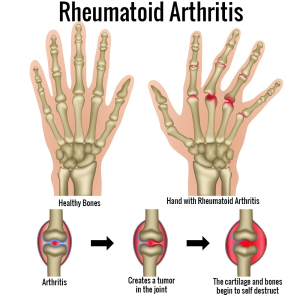 different types of arthritis