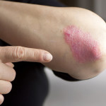 Difference between Eczema and Psoriasis: Causes, Signs, Treatments, Preventions