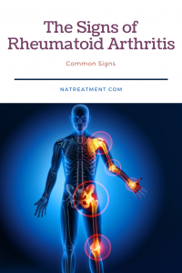 The Signs of Rheumatoid Arthritis