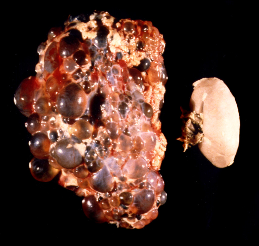 polycystic kidney disease
