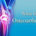 What is Osteoarthritis Disease?