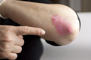difference between eczema and psoriasis