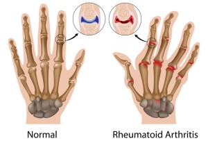 does cracking knuckles cause arthritis