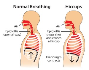 how to get rid of hiccups fast