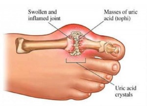 natural remedies for gout