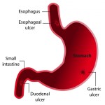 Throwing Up Stomach Acid: Causes, Preventions, and Treatments