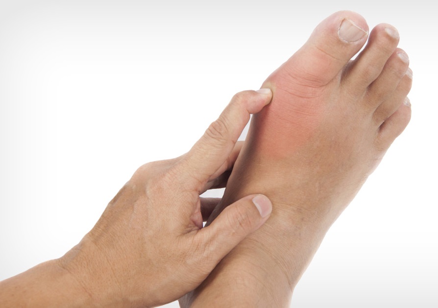 what does gout look like
